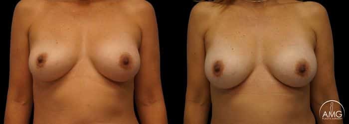 breast implant revision patient