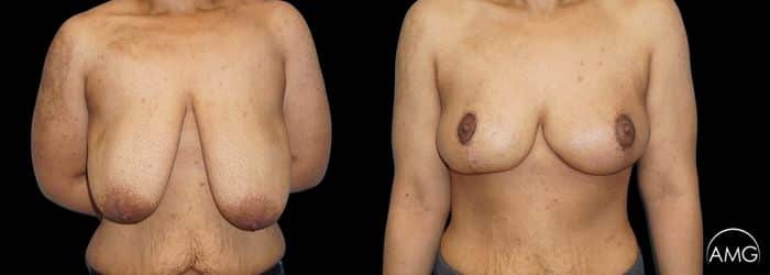 Breast lift result