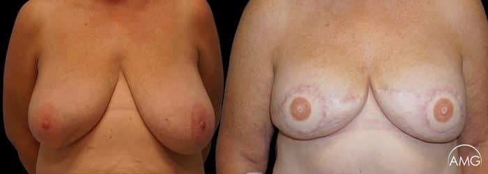 breast reconstruction result