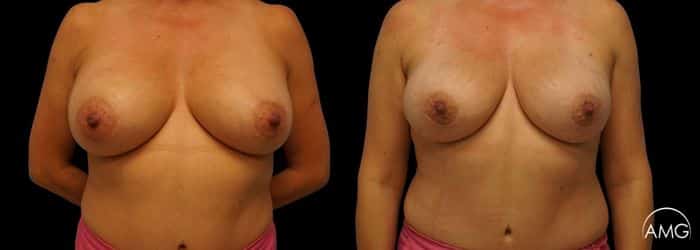 breast reconstruction photo