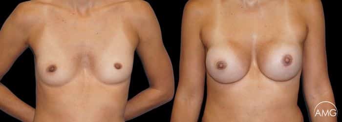 breast implant photo