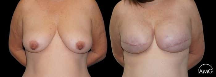 breast surgery photo