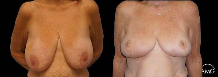 breast reconnection result