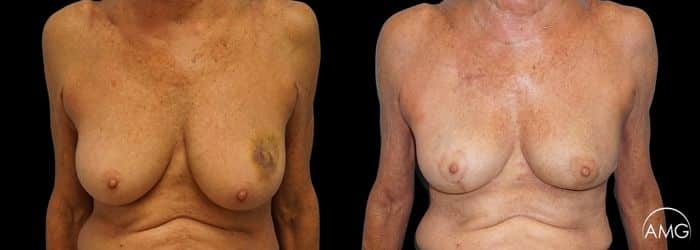 breast reconstruction result