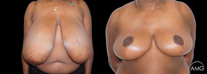 breast reduction result