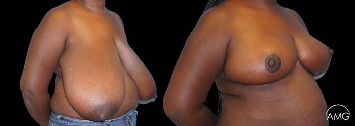 breast reduction result photo