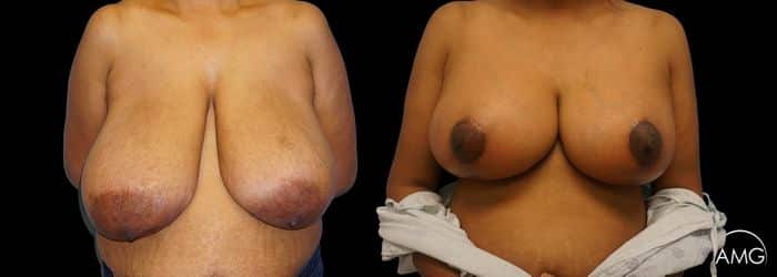 breast reduction photo