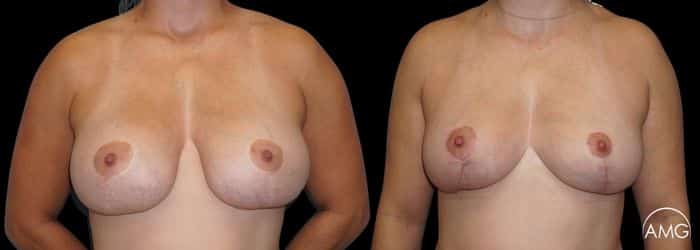 breast revision patient