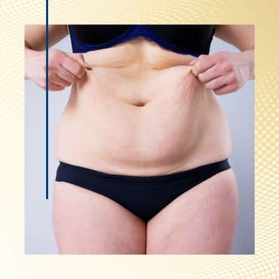 tummy tuck after weight loss