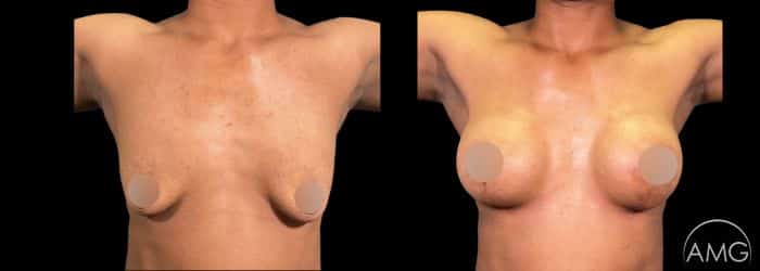 breast augmentation transformation plastic surgery