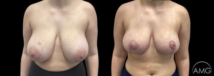 breast reduction before and after transformation plastic surgery