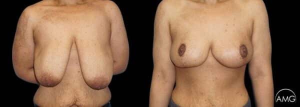 AMG Plastic Surgery Breast Lift 1 Patient 1 600x214 1