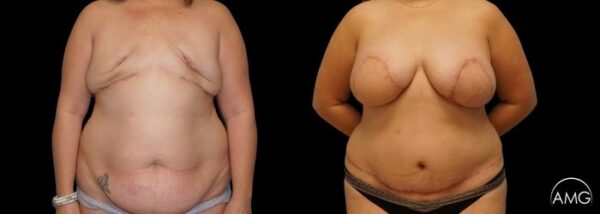 AMG Plastic Surgery Breast Reconstruction DIEP 1 Patient 1.jpg 600x214 1