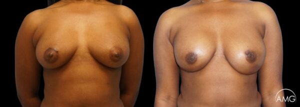 AMG Plastic Surgery Breast Reconstruction Direct To Implant 1 Patient 3 600x214 1 1