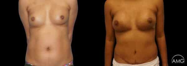 AMG Plastic Surgery Breast Reconstruction Hybrid Diep Patient 1 600x214 1