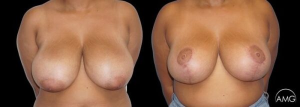 AMG Plastic Surgery Breast Reduction Patient 3 600x214 1