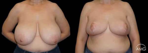 AMG Plastic Surgery Breast Reduction Patient 6 600x214 1