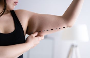 A woman in a black tank top pinches the excess skin with pre-surgical marking on her upper arm.