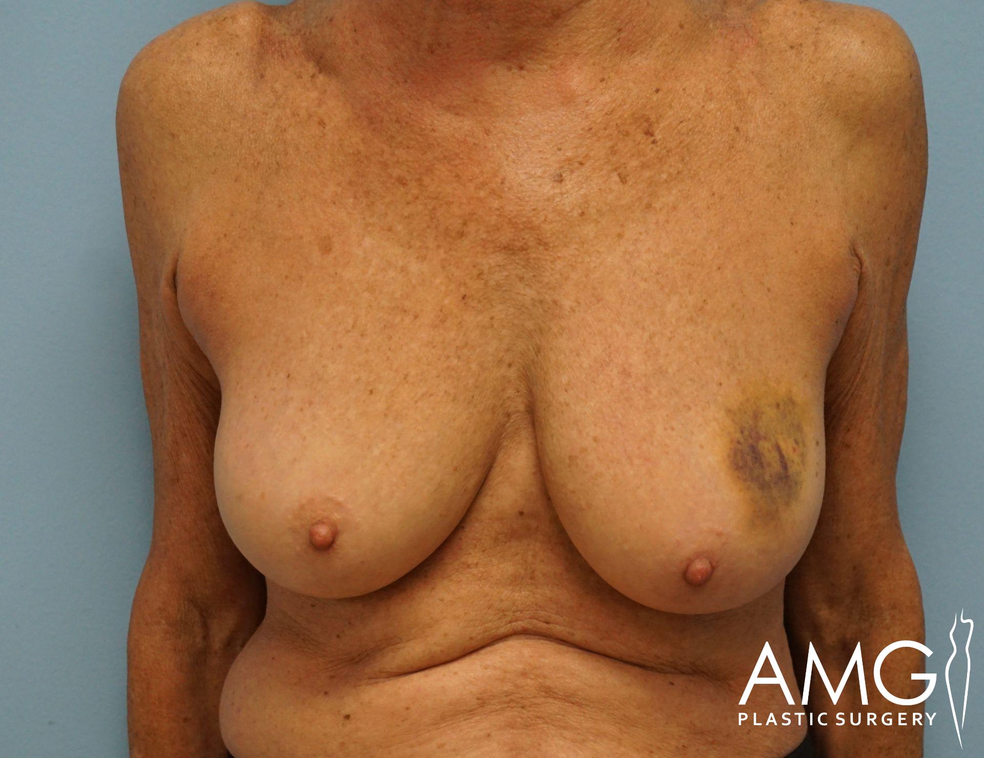 Person with visible bruising on the right side of the chest, against a blue background. Plastic surgery logo present.