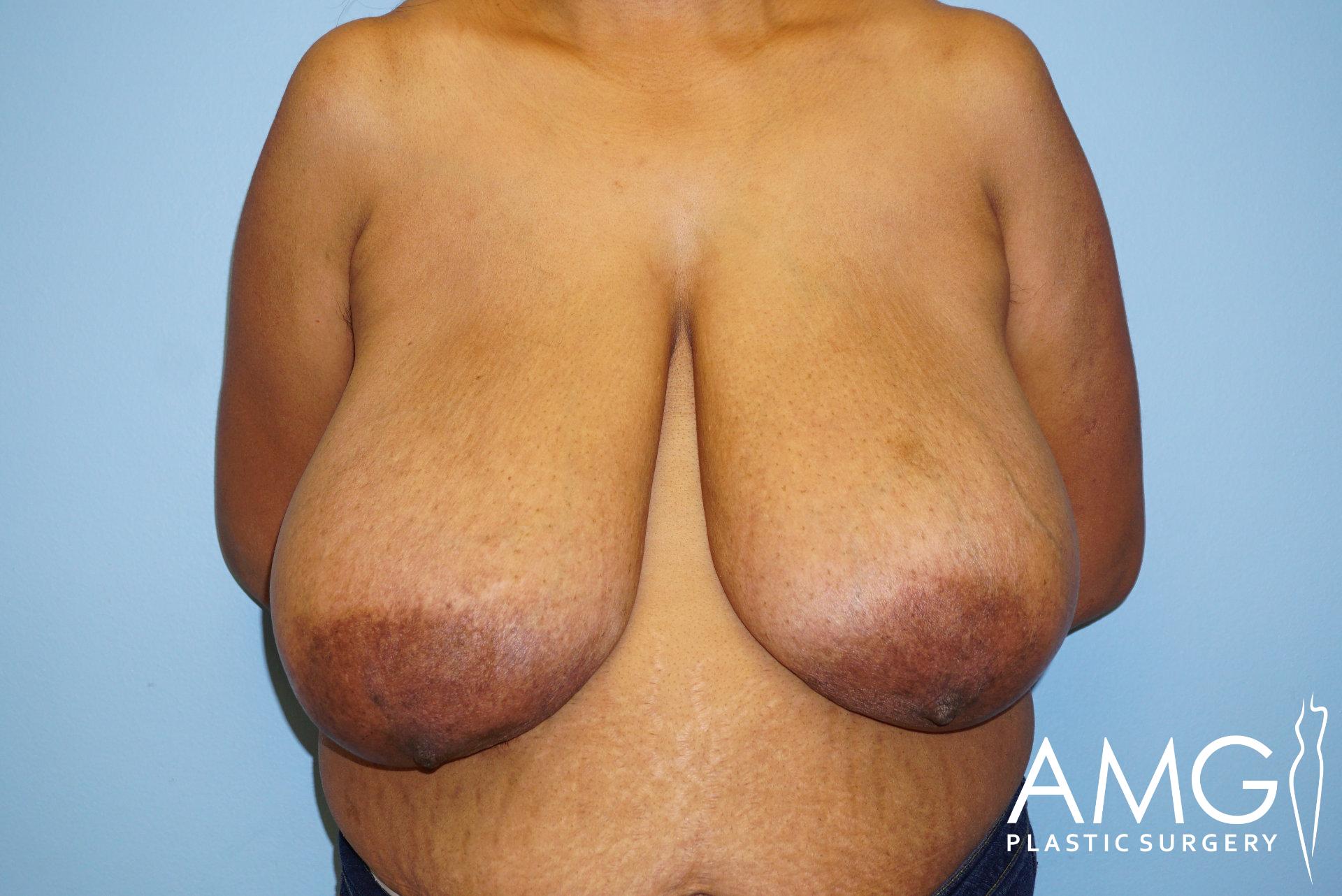 Person with significant breast hypertrophy standing against a blue background, with a logo reading "AMG Plastic Surgery" at the bottom right.