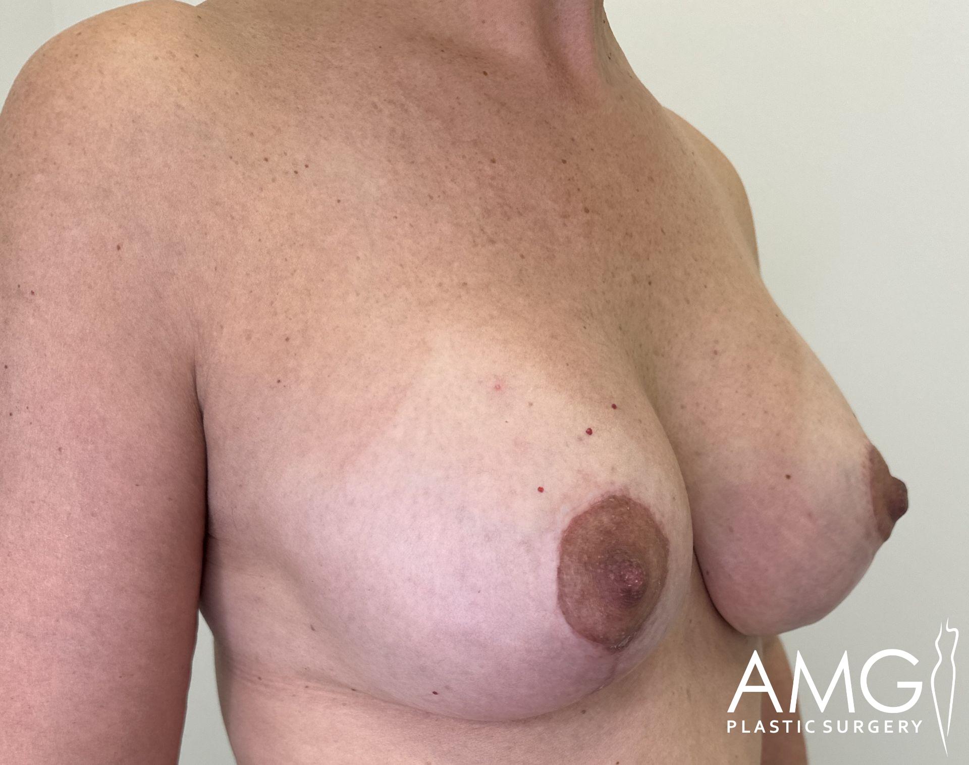 Person's chest showing post-surgery healing with visible stitches or marks. A logo in the corner reads 