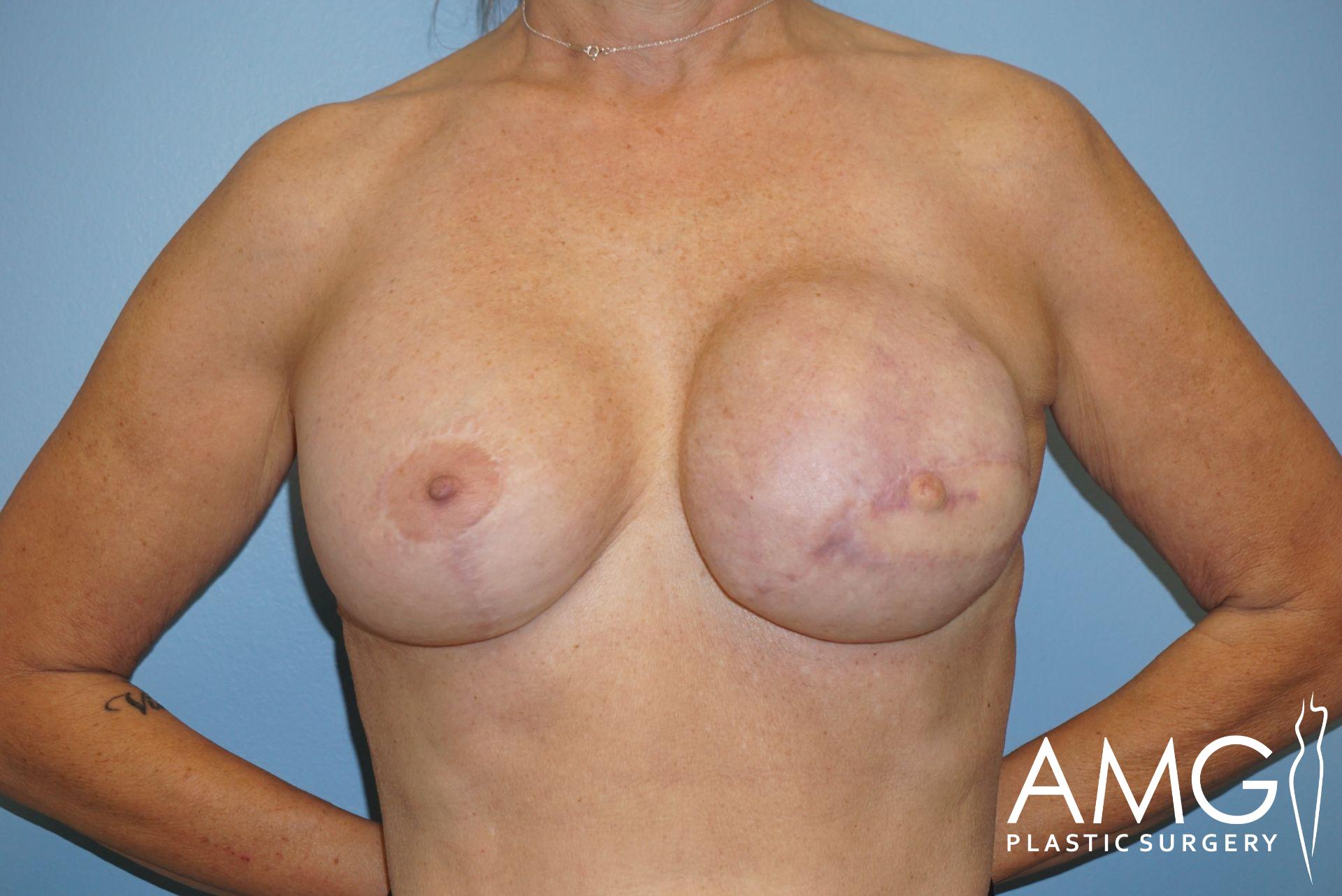 The image shows a person with visible post-surgery scars on their chest in a clinical setting, with the AMG Plastic Surgery logo in the corner.