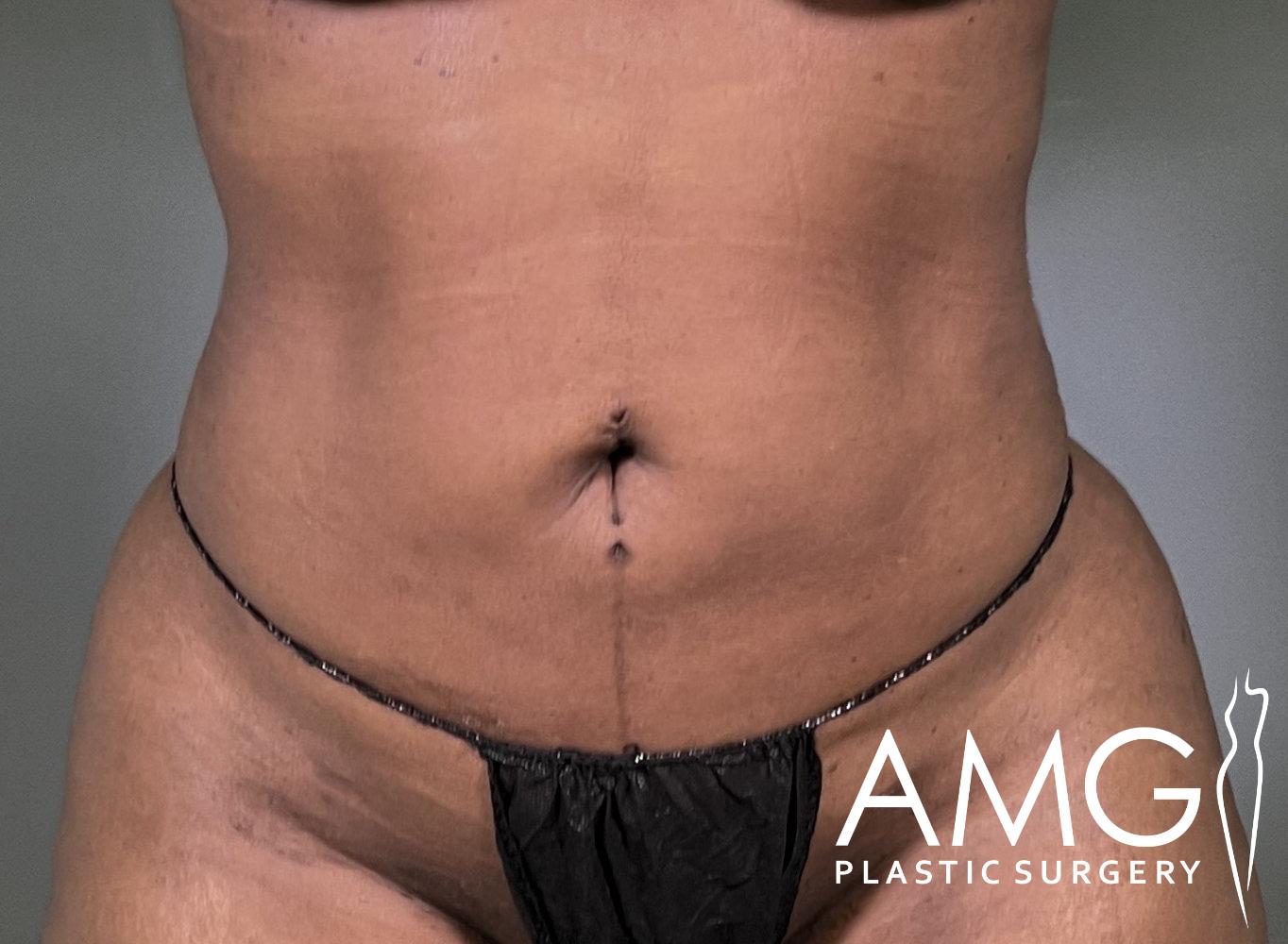 A close-up of a person's abdominal area wearing a black garment. The image includes a cosmetic surgery clinic logo in the corner.