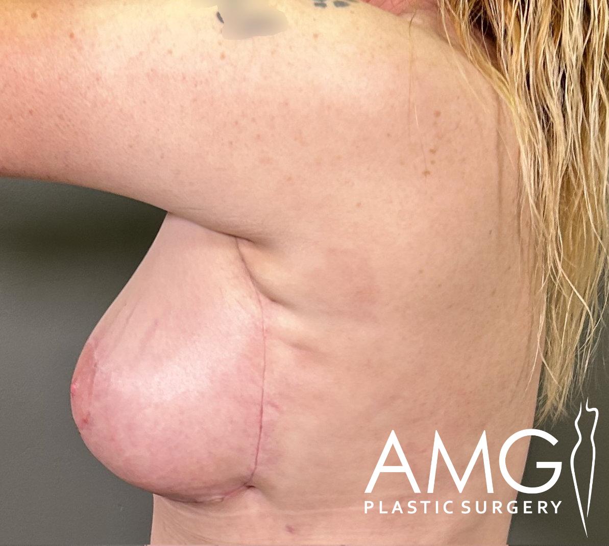 Close-up of a person’s side and breast showing a surgical scar underneath. The image includes an 