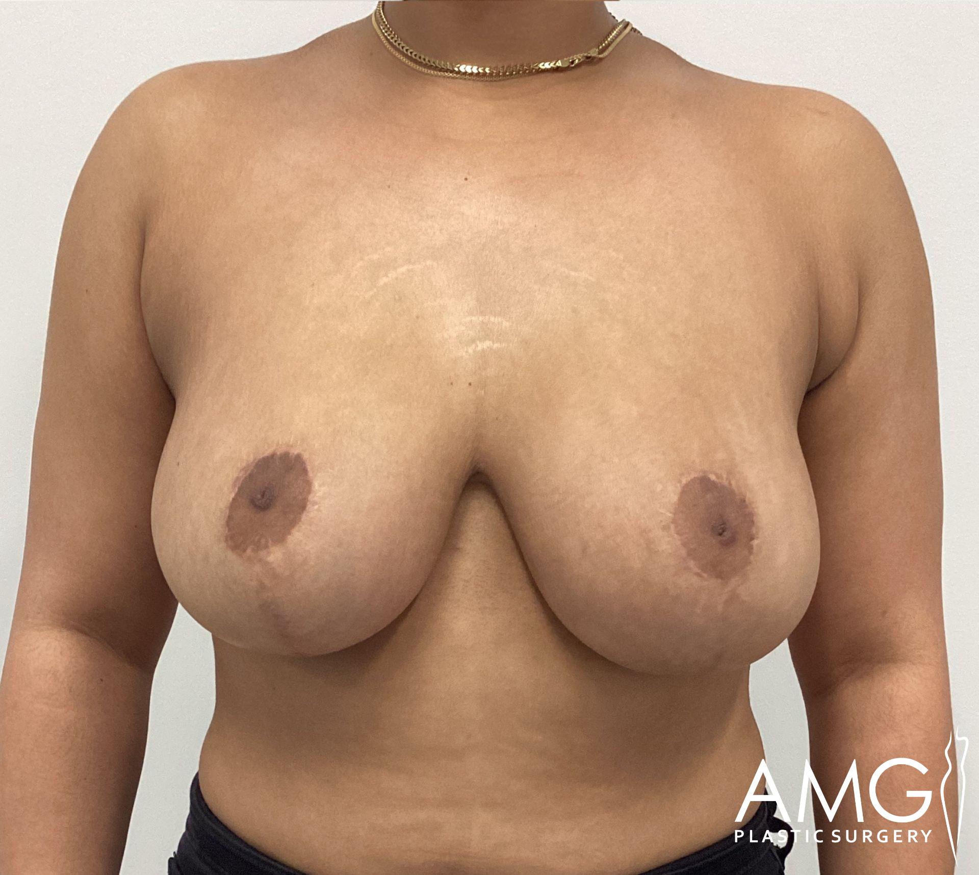 Topless person with visible surgical scars on breasts stands in front of a plain background.