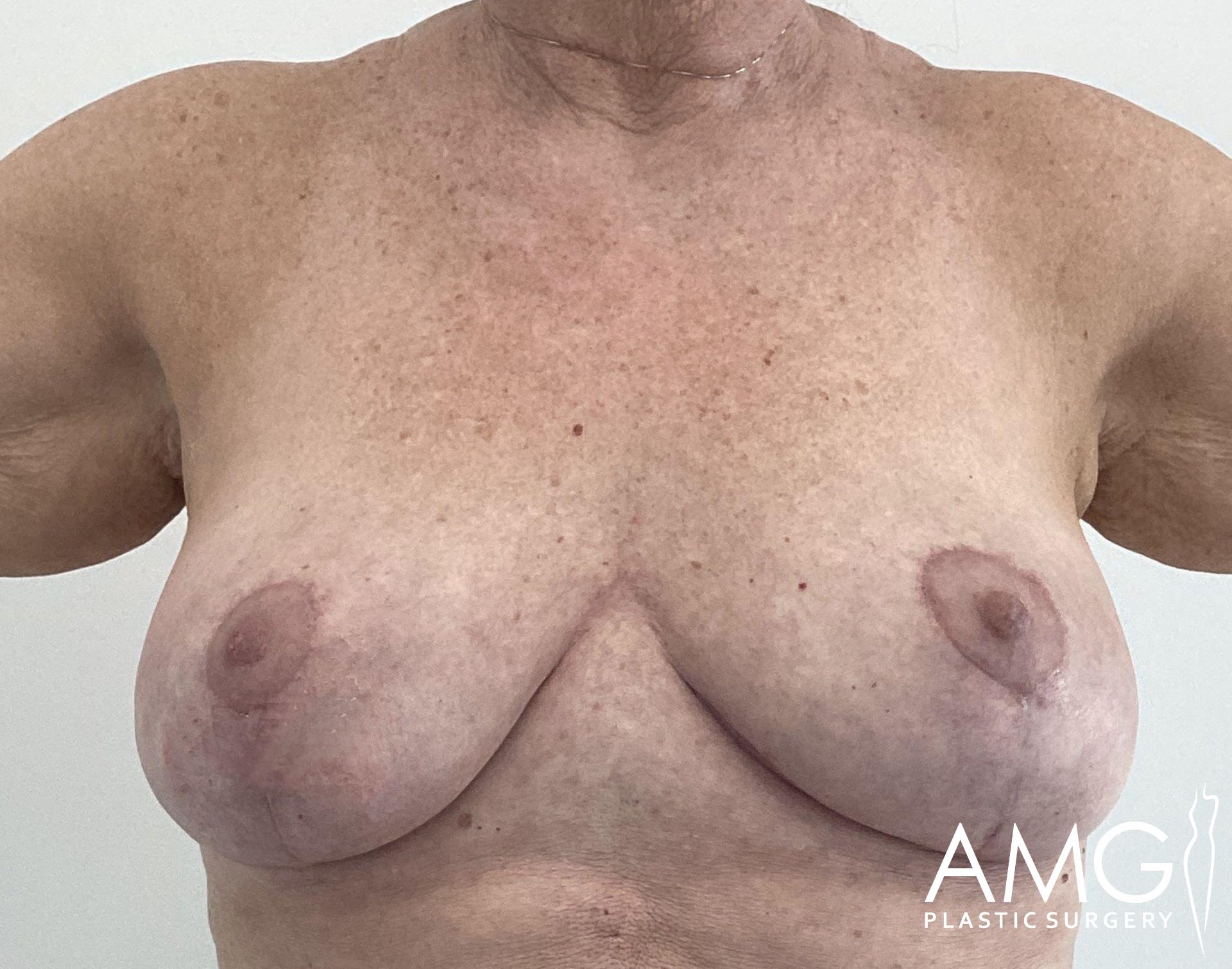 A person's chest post-surgery with visible scars beneath the breasts.