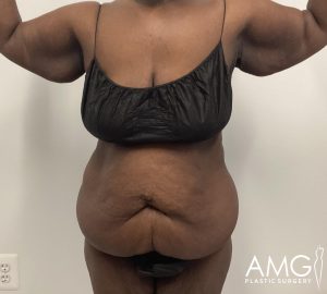 Person in black undergarments showing midsection with excess skin. Arms raised to the sides. White background with "AMG Plastic Surgery" logo in the corner.