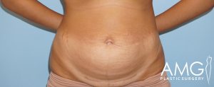 Close-up of an abdomen showing skin texture and stretch marks, with arms partially visible; "AMG Plastic Surgery" logo on the bottom right.