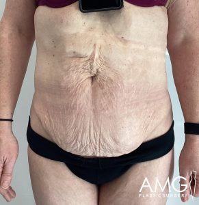 Close-up of a person’s abdomen with visible skin folds and surgical markings. They wear black shorts, and a device hangs around the neck. The logo "AMG Plastic Surgery" is visible.