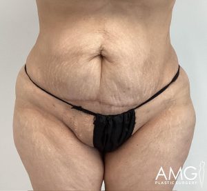 A close-up of a person's midsection, showing abdominal skin with stretch marks and slight sagging. The individual is wearing a black garment. The image has "AMG Plastic Surgery" logo.