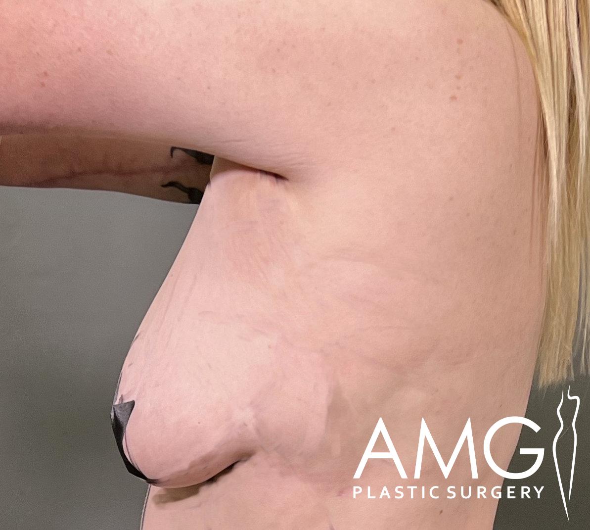 Side view of a person's bare armpit area showing sagging skin, with the logo "AMG Plastic Surgery" visible in the bottom corner.