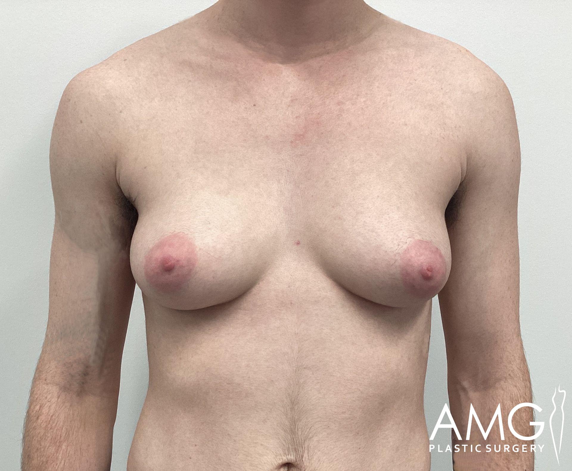 Individual with gynecomastia, characterized by enlarged breast tissue, standing shirtless against a plain background. White text on the bottom right corner reads "AMG Plastic Surgery.