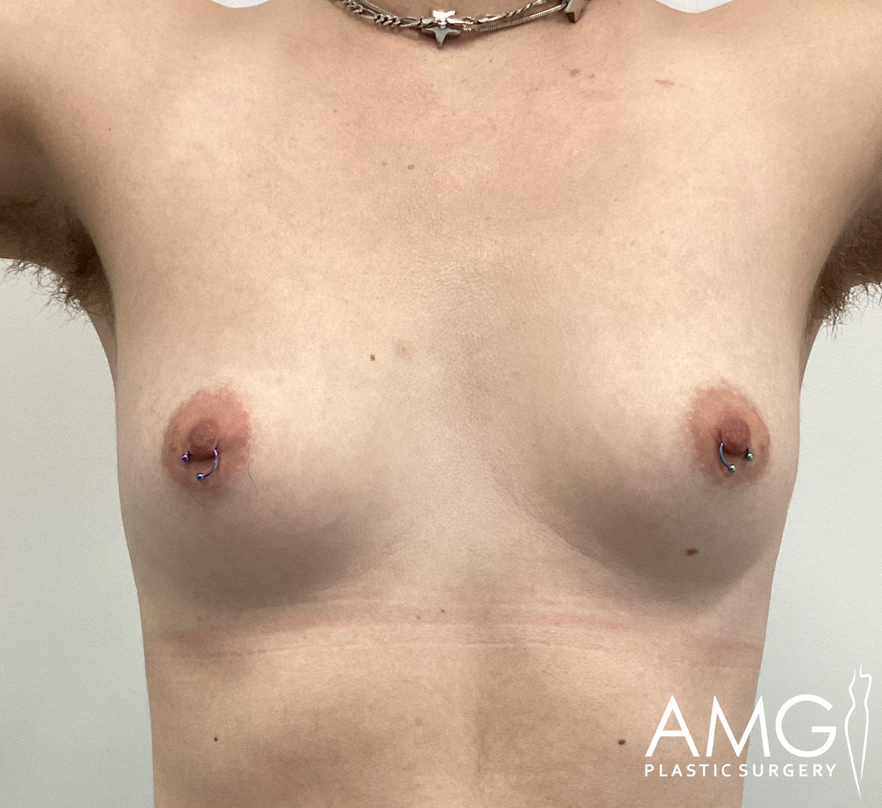 Person with pierced nipples and visible arm hair stands against a plain background. The logo "AMG Plastic Surgery" is visible in the corner.