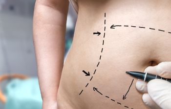 A person's abdomen marked with dashed lines and arrows, indicating preparation for a body contouring procedure.