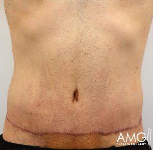 Close-up of a person's abdomen showing a healed surgical scar running horizontally along the lower stomach. The skin appears healthy with visible hair and a logo for AMG Plastic Surgery is present.