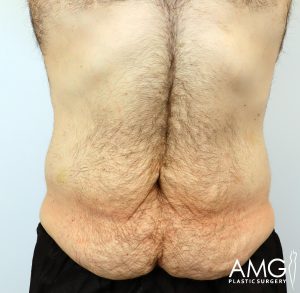 Close-up of a person’s lower back showing skin folds and body hair. Logo in the bottom right corner reads "AMG Plastic Surgery.