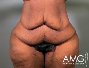 A close-up of a persons abdomen and upper thighs with loose, sagging skin. The person is wearing black underwear. The image features the AMG Plastic Surgery logo in the lower right corner.