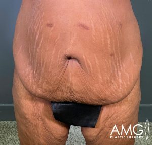 A close-up of a person’s lower abdomen and upper thighs, showing loose skin, stretch marks, and a black rectangle covering the genital area. AMG Plastic Surgery logo is visible in the bottom right corner.