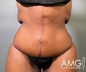 Front view of a woman's abdomen after fleur-de-lis tummy tuck showing a flatter, more contoured abdomen with a visible vertical scar, AMG Plastic Surgery.