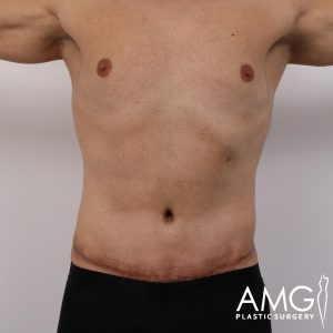 Front view of a man's abdomen after tummy tuck showing a flatter and more contoured abdomen, AMG Plastic Surgery.